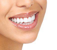 veneers